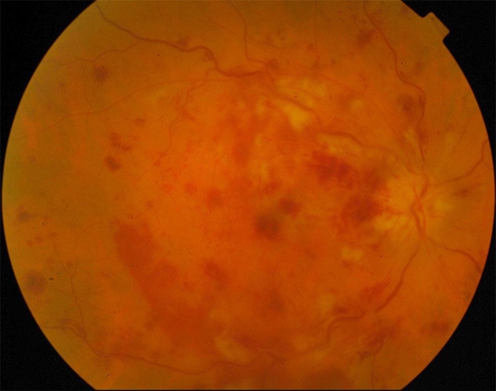 Hémorragie oculaire, vaisseaux nourriciers de l'oeil bouchés