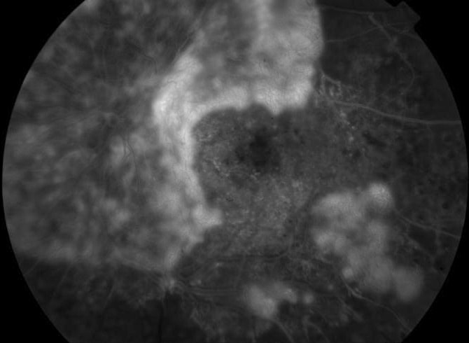 Membranes néovasculaires, angiographie à la Fluorescéine