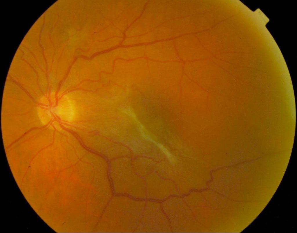 Membrane épirétinienne, provoquant une baisse de vision