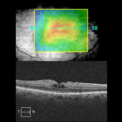 Tomographie par OCT de l'œil