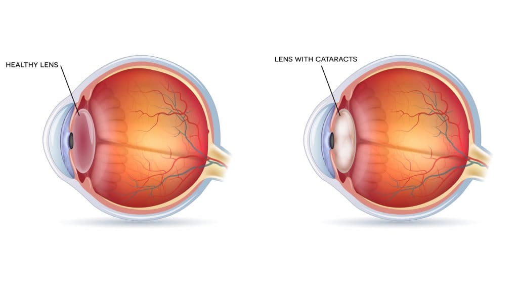 Cataracte, opacification du cristallin de l'œil