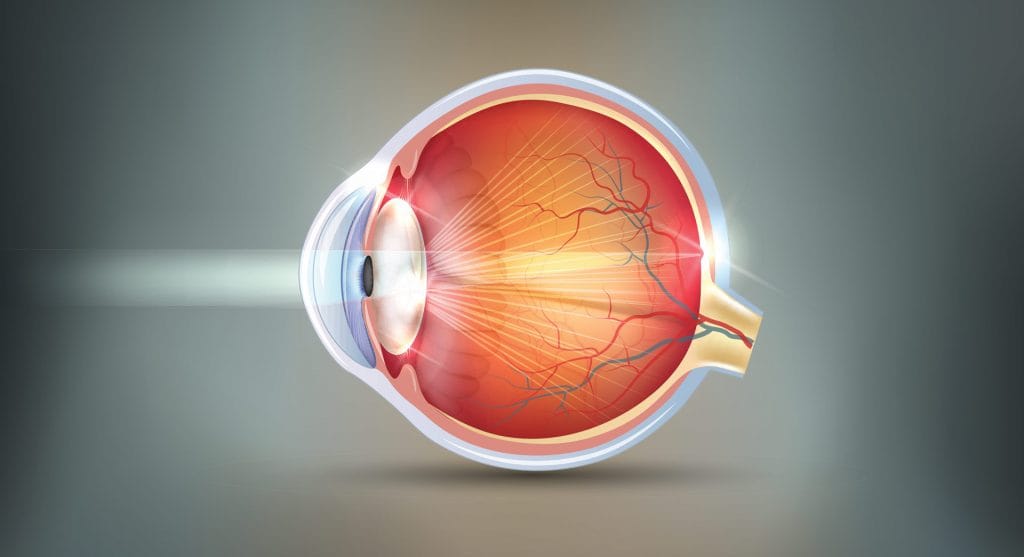 Cataracte opacification du cristallin de l'œil provoque des éblouissement
